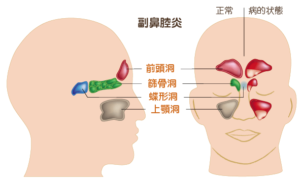 副鼻腔炎